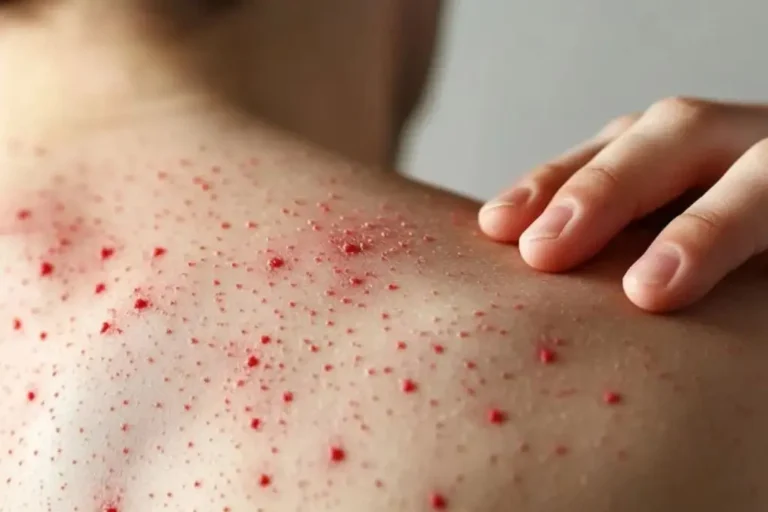 ¡Cuídese del sarampión! Reportan 92 casos en Tabasco